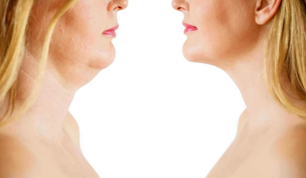 Double Chin treatment Greater London (Brent) before and after results