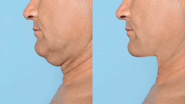 Which Non-Surgical Treatments Work Best for Jowls and Loose Skin Greater London (Brent)?