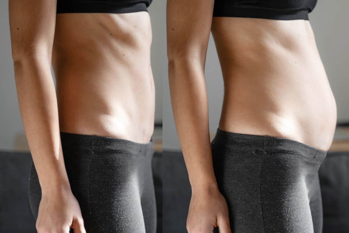 How long does diastasis recti take to improve Greater London (Brent)?