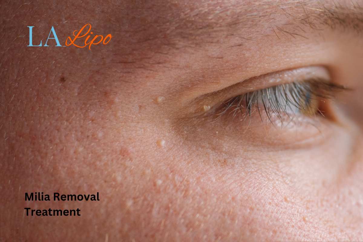 Cryopen Milia Removal: Is It the Easiest and Safest Option Greater London (Brent)?