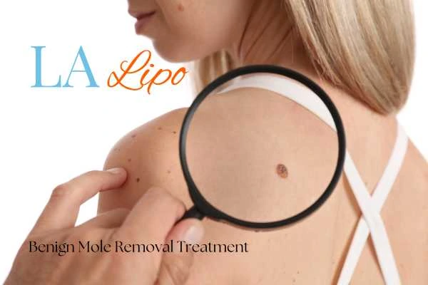 Why getting moles removed Greater London (Brent) can boost your confidence!