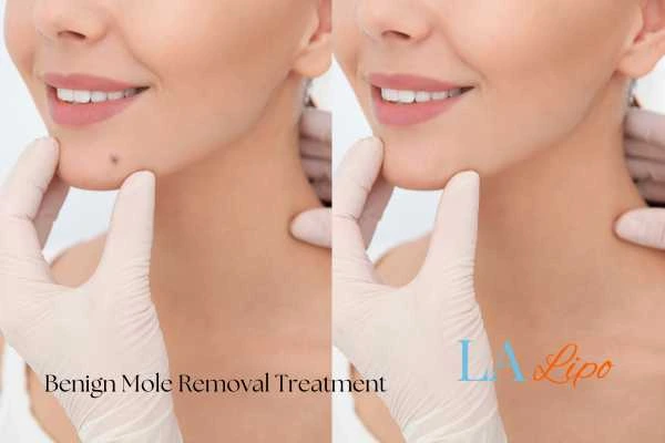 Woman's before and after results of being moles removal treatment Greater London (Brent)