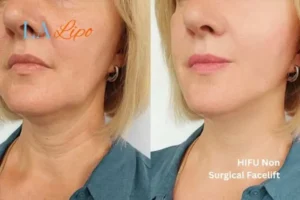 hi-fu for wrinkles Greater London (Brent) before and after results