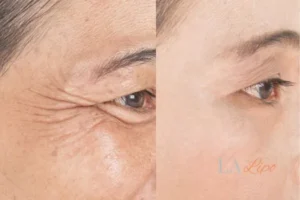 Before and after results of woman - HI-fu wrinkles reduction treatment Greater London (Brent)