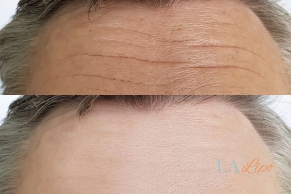 results of HIFU Greater London (Brent) on mans forehead to help reduce lines and wrinkles