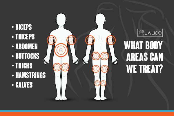Graphic to show areas you can have LA-EMS Body Sculpting Greater London (Brent) treatment.