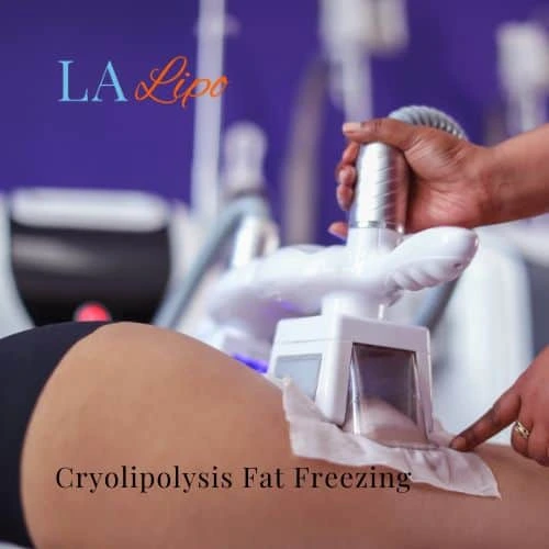 fat freezing - Cryolipolysis Greater London (Brent)