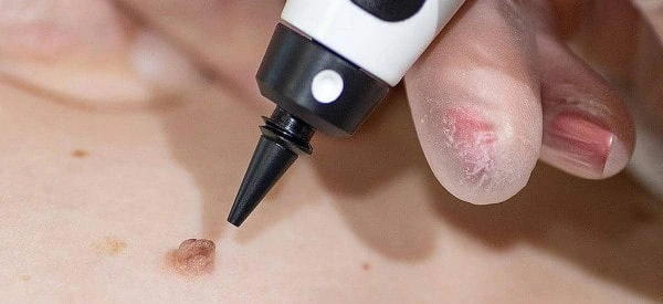 skin tag removal using cryopen Greater London (Brent)