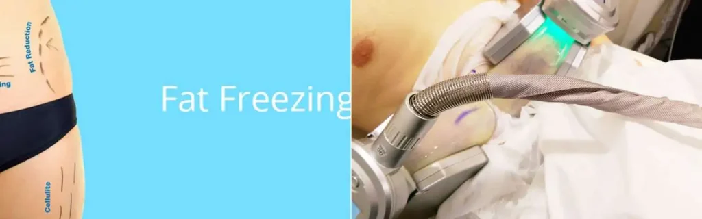 multi areas of a persons body having coolsculpting Greater London (Brent) treatment