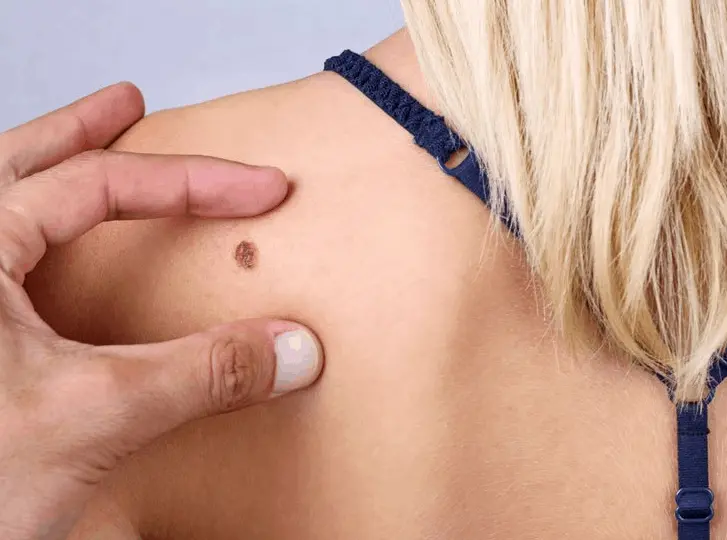 woman having mole removal Greater London (Brent) consultation before treatment.