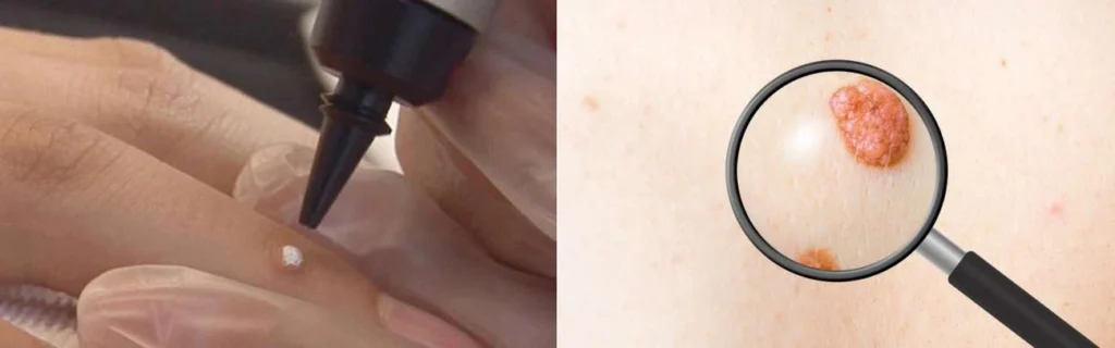 Person getting moles removed with cryopen Greater London (Brent)