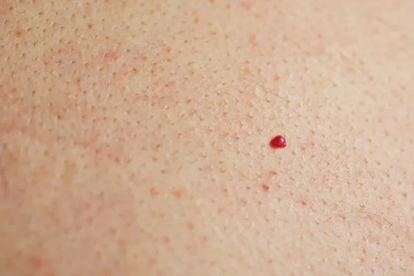 close up of a cherry angioma Greater London (Brent)