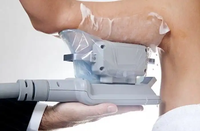 Picture of fat freezing Greater London (Brent) on the upper arms.