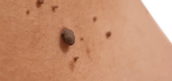 image of a skin tag Greater London (Brent)