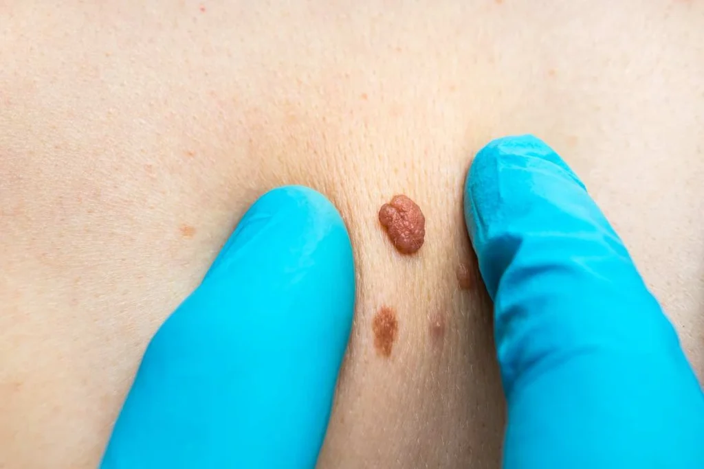 Consultant examining a skin tag Greater London (Brent)
