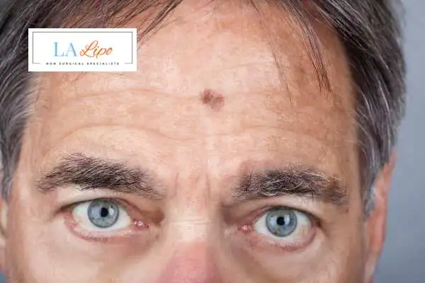 Solar Lentigo Removal Greater London (Brent) image of man with mark on his forehead