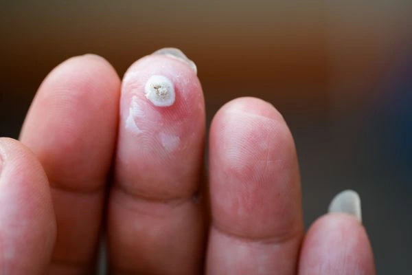 wart on person finger - cryotherapy to treat from LA LIPO Greater London (Brent)
