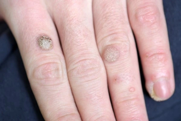 photo of warts on person hand - see wart removal Greater London (Brent) from LA LIPO