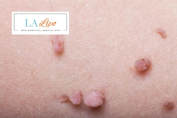 Does cryopen skin tag removal Greater London (Brent) hurt? Find out now call our team today!