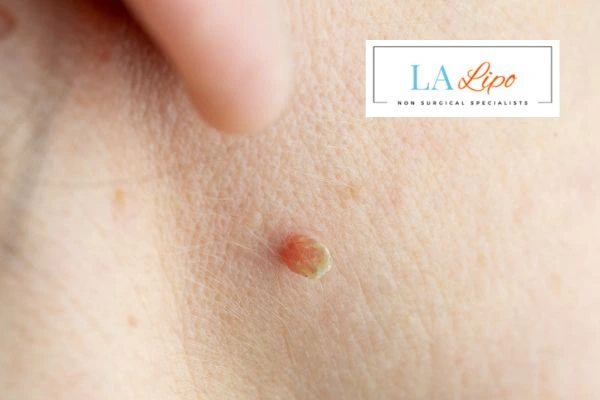 Book skin tag removal Greater London (Brent) today speak to our team now!