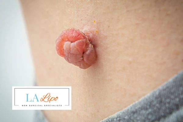 Interested in skin tag removal Greater London (Brent)? Concerned about the pain? Find out more today!