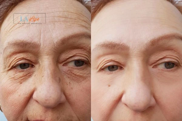 The powerful benefits of Morpheus8 Treatment Greater London (Brent) - Call Our team today!