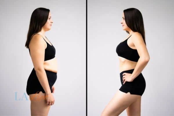 Picture of womans before and after using LA-EMS body sculpting to improve her core strength Greater London (Brent)