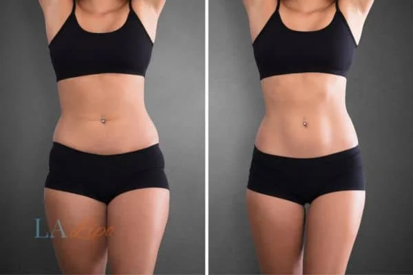 before and after results of non-surgical treatment to help a woman's body image and mental health Greater London (Brent)