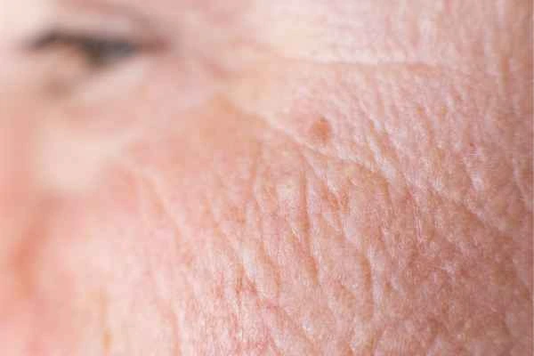close up picture of a woman's face showing an age spot Greater London (Brent)