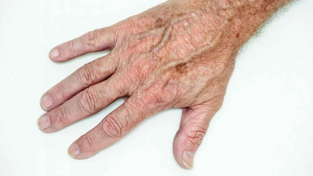 Male hand showing age spot Greater London (Brent)