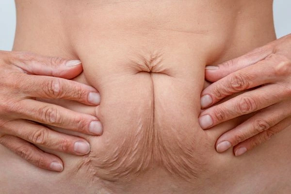 Image of a woman's stomach with loose skin - example of skin tightening Greater London (Brent) options